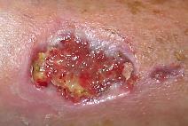 Ulcers 4