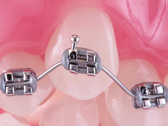 Resists Permanent Deformation Tanzo s flexibility and resistance to permanent deformation allow the wires to work in the mouth for longer intervals, which may result in fewer wire changes and lower