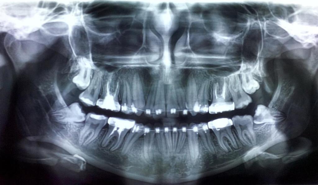 42 Ormenișan Alina et al. / Acta Medica Marisiensis 2017;63(1):41-45 contact between the inferior alveolar nerve and the impacted lower third molars.