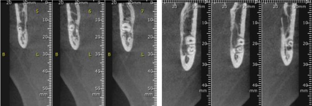 The panoramic radiography (Figure 1) showed mandibular canal image superimposed over the third molar roots, on both sides.