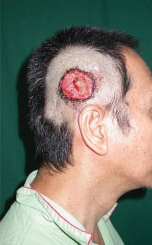 FIGURE 1. A 55-year-old man with a fungating lesion in a sebaceous nevus in right temporal scalp. [Color figure can be viewed in the online issue, which is available at www.interscience. wiley.com.