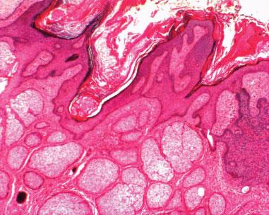 FIGURE 4. Photomicrograph shows features of sebaceous nevus and basal cell carcinoma (original magnification 3 4). FIGURE 6.
