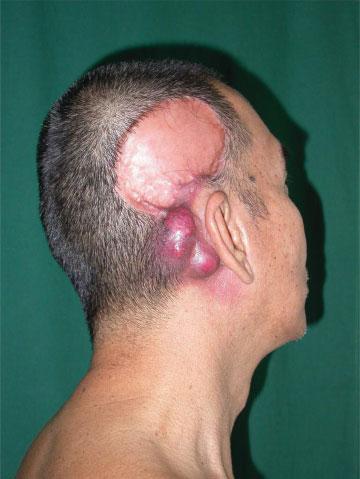 Later in life, in the fourth to seventh decade, they may develop neoplasm of epidermal, adnexal, or mesenchymal origin, the most common being basal cell carcinoma. FIGURE 5.