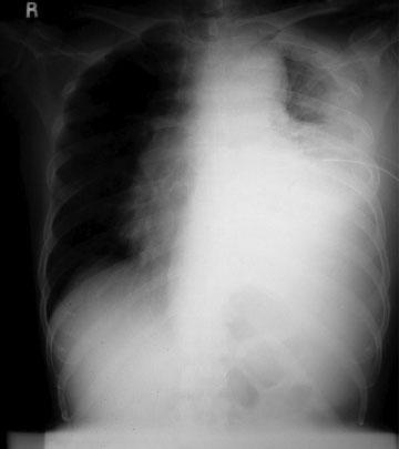 FIGURE 8. Chest X-ray taken 5 months after radical neck dissection shows left pleural effusion. The treatment of sebaceous nevus of Jadassohn has been a subject of much debate.