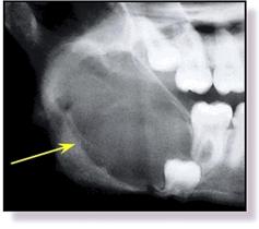 Introduction The odontogenic keratocyst (OKC) was first described in 1876 1 and named by Phillipsen in 1956. 2 It is one of the most aggressive odontogenic cysts of the oral cavity.