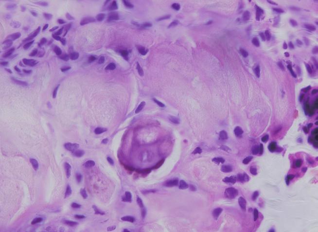 mia/lymphoma-2 (BCL-2) are expressed chiefly in odontogenic cyst lining epithelial cells.