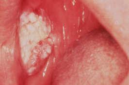 Dysplastic or SCC (%) FOM 43 Tongue, ventral or lateral 24