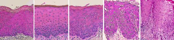 mucosa/sulcus 15 Retromolar area 12 Increasing severity