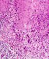 Histologic Molecular Hyperplasia Mild Dysplasia Severe