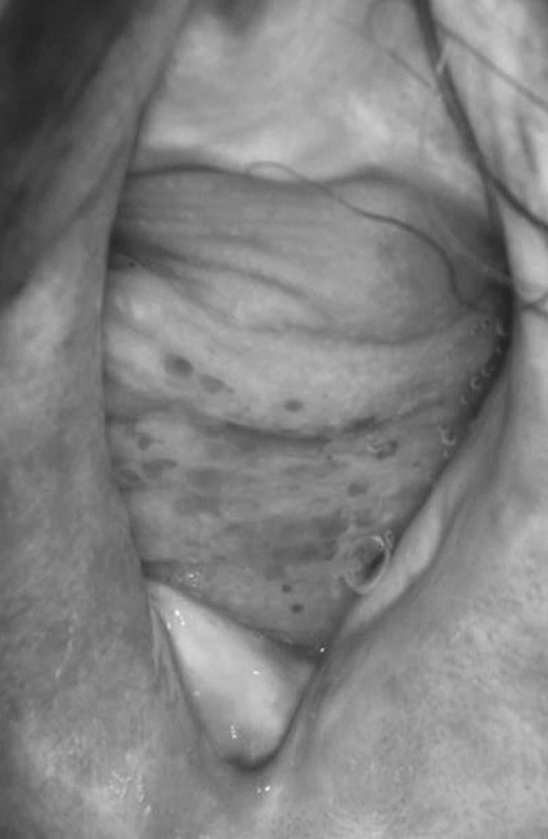 Colposcopic picture of the upper vaginal wall after the first application of FemiLift laser ical physical examination, transvaginal ultrasound, post - void bladder ultrasound, as well as cough test