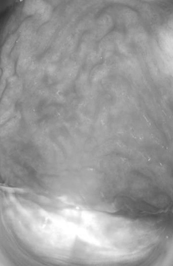 Colposcopic picture of the vaginal wall one month after the application of the third session of FemiLift laser small, moderate or large amounts of urine during activities that require increased