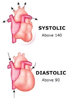 Introduction The American Heart Association (AHA) defines hypertension, or high blood pressure (HBP), as systolic pressure of 140 mm Hg or higher, diastolic pressure of 90 mm Hg or higher, or taking