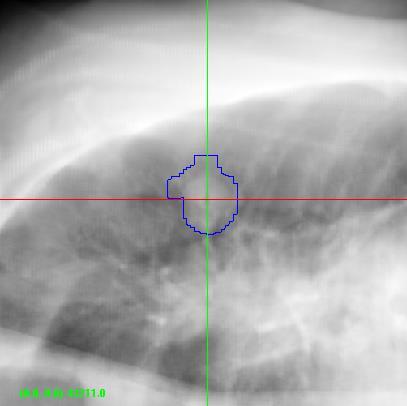 Lung Tracking