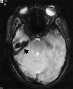 loss of signal with blooming artifact in the subarachnoid