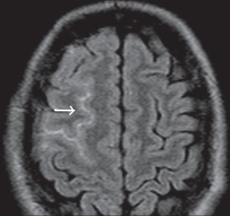 Reversible Cerebral Vasoconstriction Syndrome Definition: Condition associated with reversible constriction of the cerebral arteries Patients typically present with thunderclap headache and can also