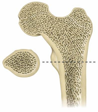 Side view and cross-section of bone (femur) Spongy bone Side view Normal bone structure Normal bones are composed of a shell of compact or solid bone surrounding connecting plates and rods of bone