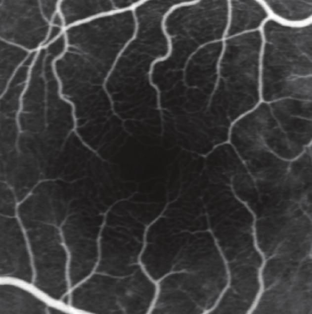 2 Journal of Ophthalmology Fluorescein angiography (c) Figure 1: Fluorescein angiography image of the central macula in a healthy subject.