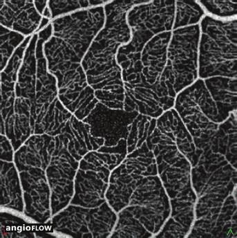 OCT angiography image (3 3 mm) of the deep vascular plexus (c) showing a close-knit pattern of vessels around the foveal avascular zone.
