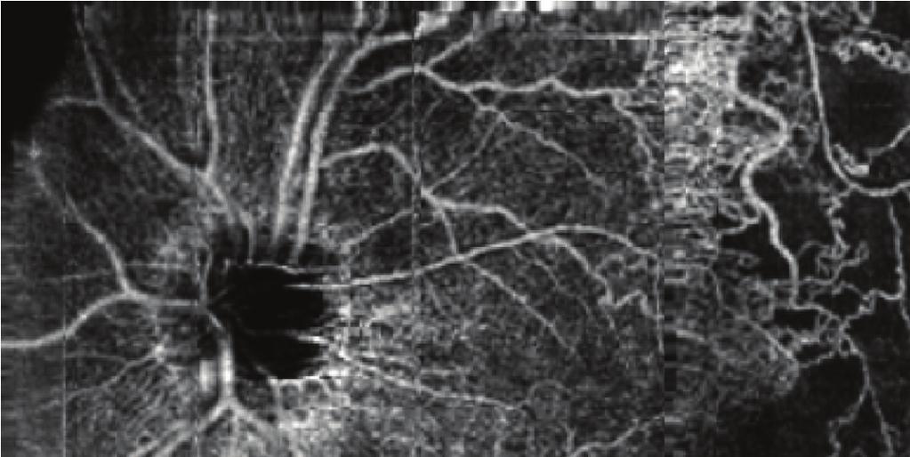 Journal of Ophthalmology 3 Figure 2: OCT angiography (composition map of three partially overlapping 8 8
