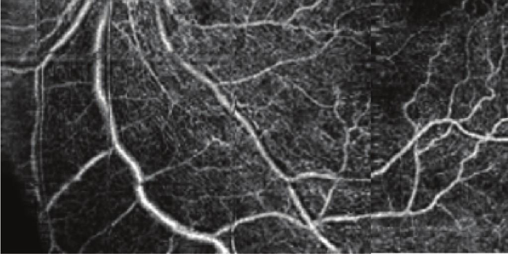 (c) Figure 3: Branch retinal vein occlusion (BRVO) of a 53-year-old woman: OCT angiography (8 8 mm)