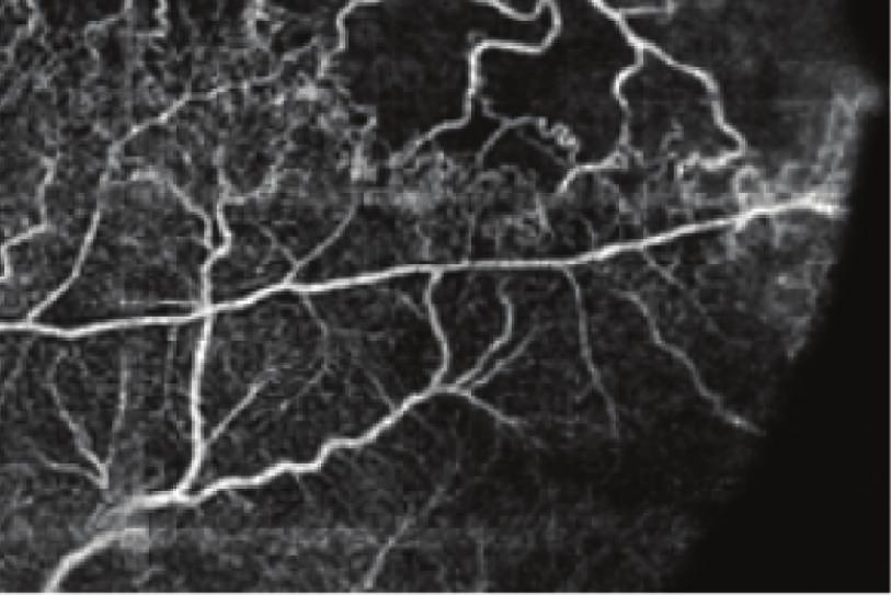 angiography. Longitudinal B-scan demonstrating the reference lines of the superficial plane (c).