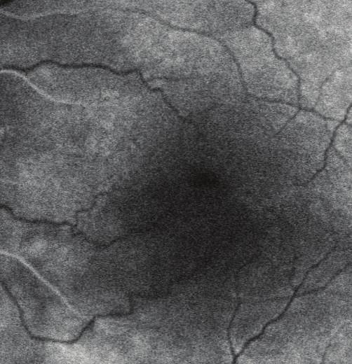 Low flow area in OCT-angiography (6 6 mm) image (c).