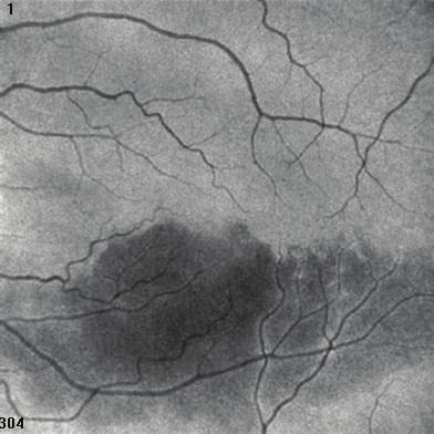 The main finding was the low flow area in OCT- A, which correlated with the area of hypofluorescence in FA due to retinal artery hypoperfusion.