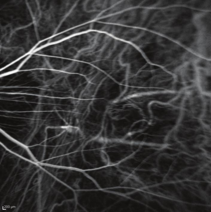 Indocyanine green angiography arteriovenous