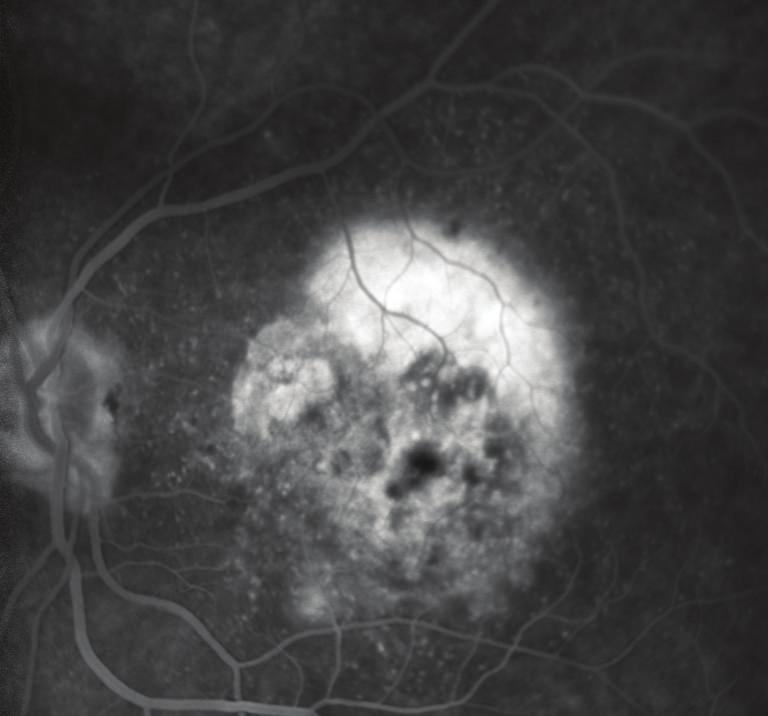 6 Journal of Ophthalmology Figure 7: Fluorescein angiography shows late leakage from classical choroidal neovascularization.