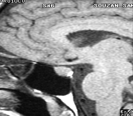 Pituitary gland Posterior pituitary 25% of volume Neurohypophysis = posterior pituitary + infundibular stalk + hypothalamic nuclei [ Supra optic, Para ventricular nuclei