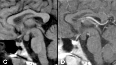 CT: Small (2cm) isodense lesion No calcification MR: Isointense
