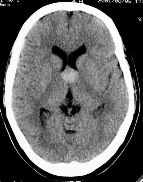 Colloid cyst 2% of all glial neoplasms Characteristic site