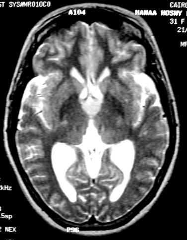 Colloid cyst 2% of all glial neoplasms MRI any signal depending on the contents T1 hyperintense or hypo intense T2 hyperintense or hypo