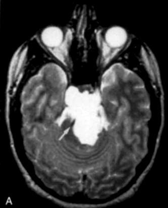 or para-sellar Benign, may be locally invasive CT: Mass with bone destruction MRI: T1 hypo,