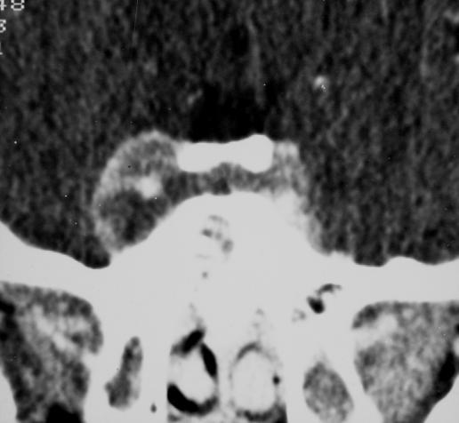 Cavernous sinus thrombosis F 25Y A rare lesion caused by infection starting in the face, ear or sinuses specially the sphenoid Peri -orbital pain, proptosis, venous congestion and ophthalmoplegia[