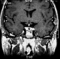 Intrasellar lesions Incidentally found pituitary lesion more than 3mm should represent