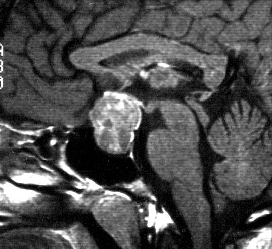 Pituitary adenoma The most common Intrasellar tumor in