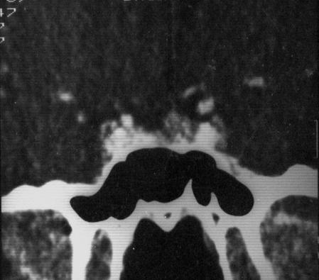 Microadenoma F 24Y Focal nonenhancing lesion within pituitary gland Surface bulge superior or inferior Convex