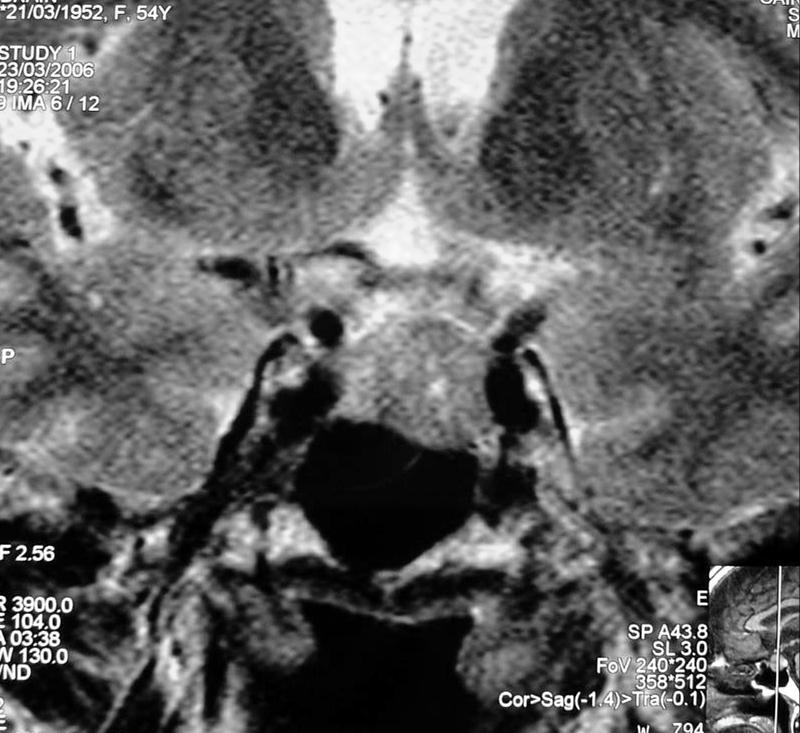 Macroadenoma F 54Y CT : MRI :