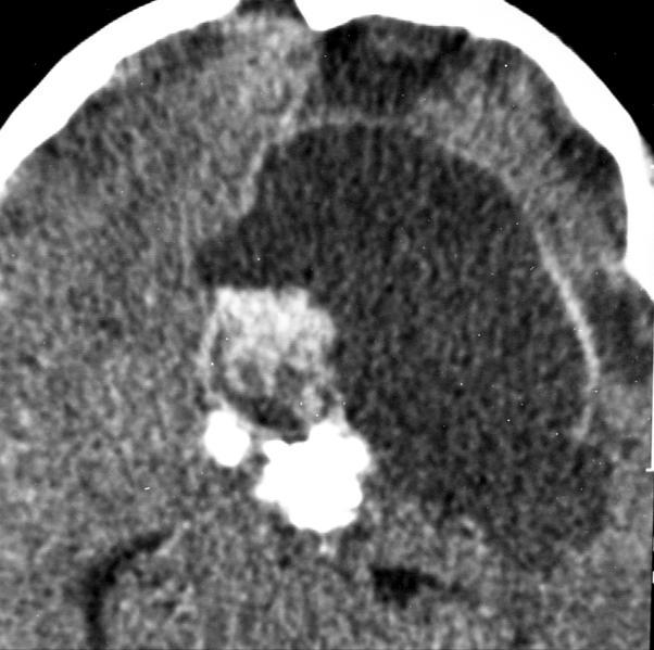 Craniopharyngioma Item Incidence Calcium Cyst Shape Age Vascular encasement Recurrence Adamantinomatous More common Common Always present