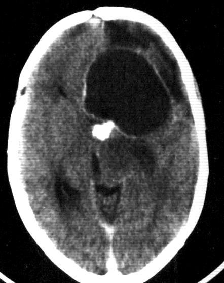 Craniopharyngioma M 16Y Lobulated suprasellar mass with cystic component The cystic component is hyperintense in T1 [protinacious contents] In T2 WIs the cyst may