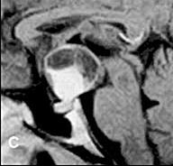 Craniopharyngioma A cystic part is present