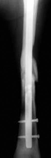 with open fractures, plate-screws in 5 cases (type IIa: 2 and type