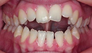 platform prior to comprehensive orthodontic treatment. This is accomplished usually within the initial 3 months of treatment.