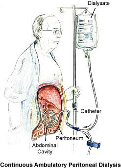 Peritoneal Dialysis (PD) An alternative dialytic treatment for patients with ESRD.