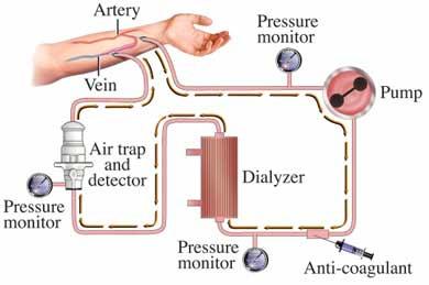 Hemodialysis Is the most common treatment for End Stage Renal Disease.