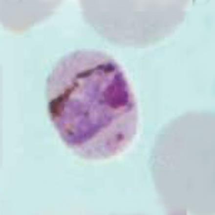 While the rapid antigen test was negative, routine slide examination using microscopy revealed the following images: Although the presumptive diagnosis was Plasmodium malariae, molecular testing