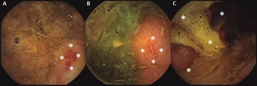 500 J. F. JUANMARTIÑENA-FERNÁNDEZ ET AL. Rev Esp Enferm Dig Fig. 1. Colonic findings during small bowel capsule endoscopy. A. Vascular lesion. B. Ulcer. C. Carcinoma.