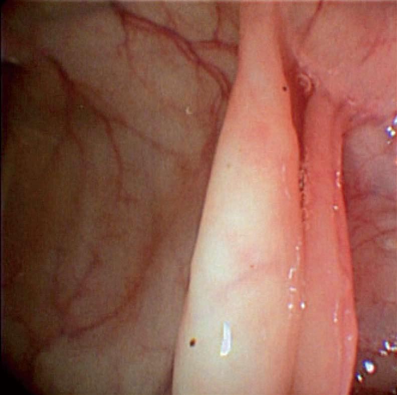 A B Figure 3 Right (A) and left (B) side view of a colonic polyp. 1 Jemal A, Bray F, Center MM, Ferlay J, Ward E, Forman D. Global cancer statistics.