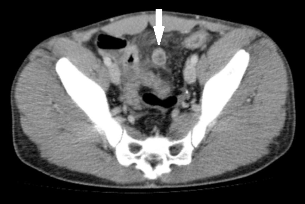 Fig. 2: Intravenous contrast-enhanced CT scan shows ght lower quadrant one thinwalled tubular structure with liquid